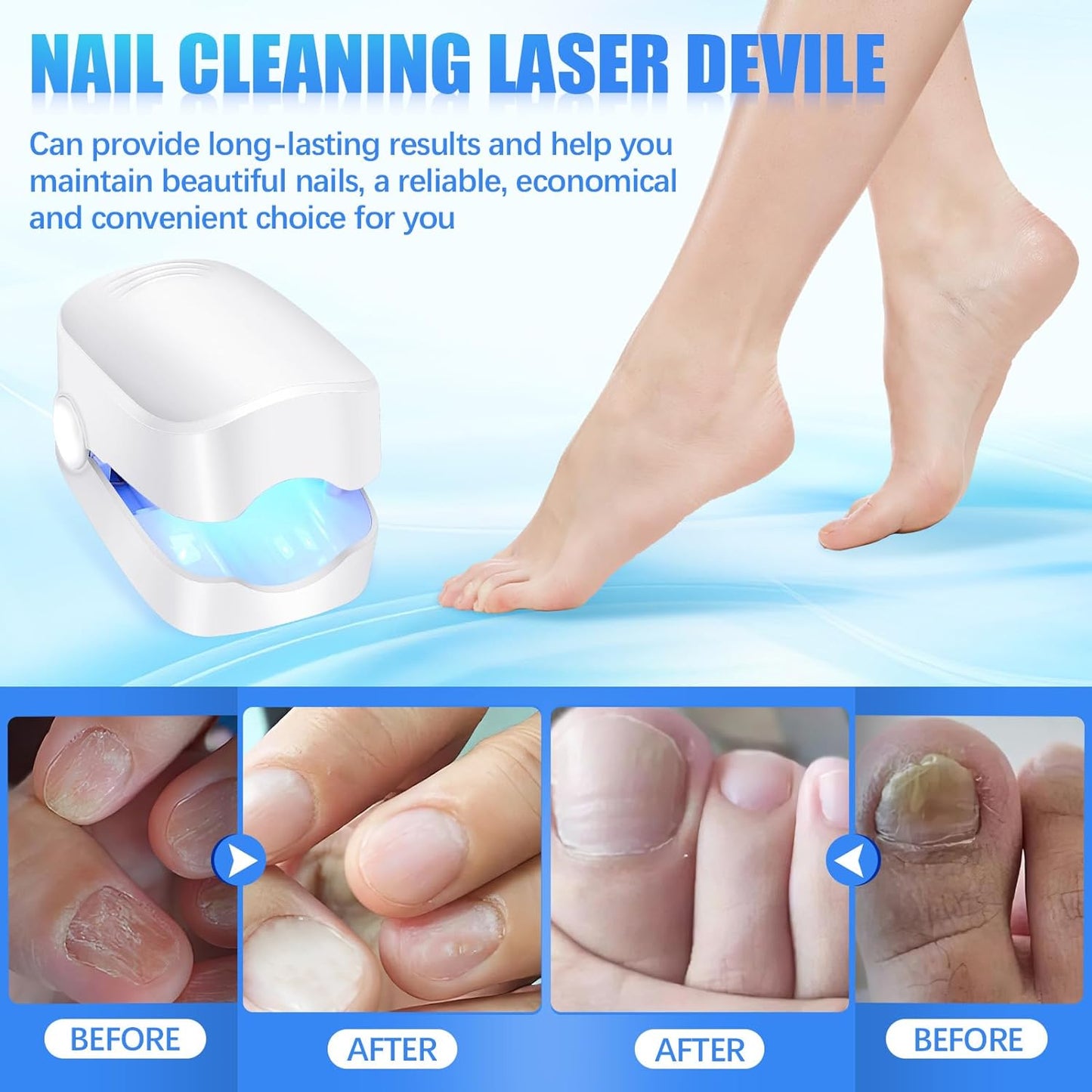 Rechargeable Nail Fungus Treatment For Toenail Toe Nail Fungal Treatment Nail Fungus Laser Device Anti-fungal Nail Treatment For Hand Feet Infections Remover For Home Use
