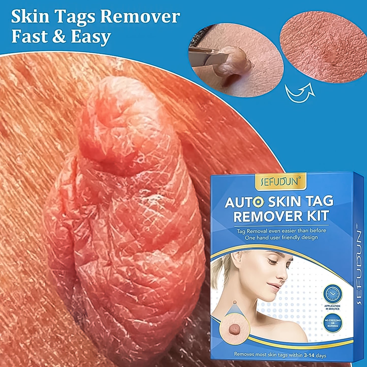Skin Tag Remover Kit 2 In 1 For Micro To Large (2 Mm - 8 Mm 1 Set)